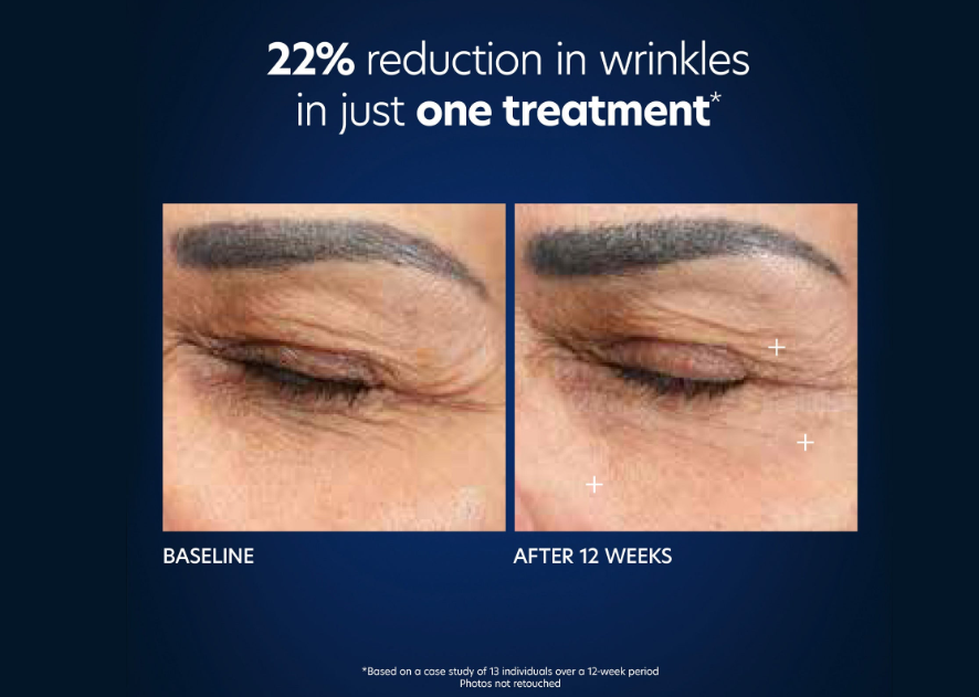 PCA Skin Hyaluronic Acid Microneedle Eye Patches